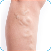 Varicose Veins