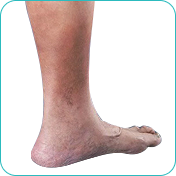 Venous Insufficiency