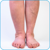 Edema & Leg Swelling